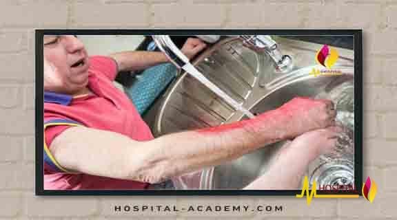 الاسعافات الاوليةللحروق