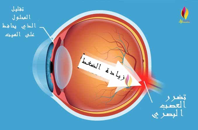 ارتفاع ضغط العين 