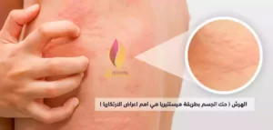 اعراض الارتكاريا