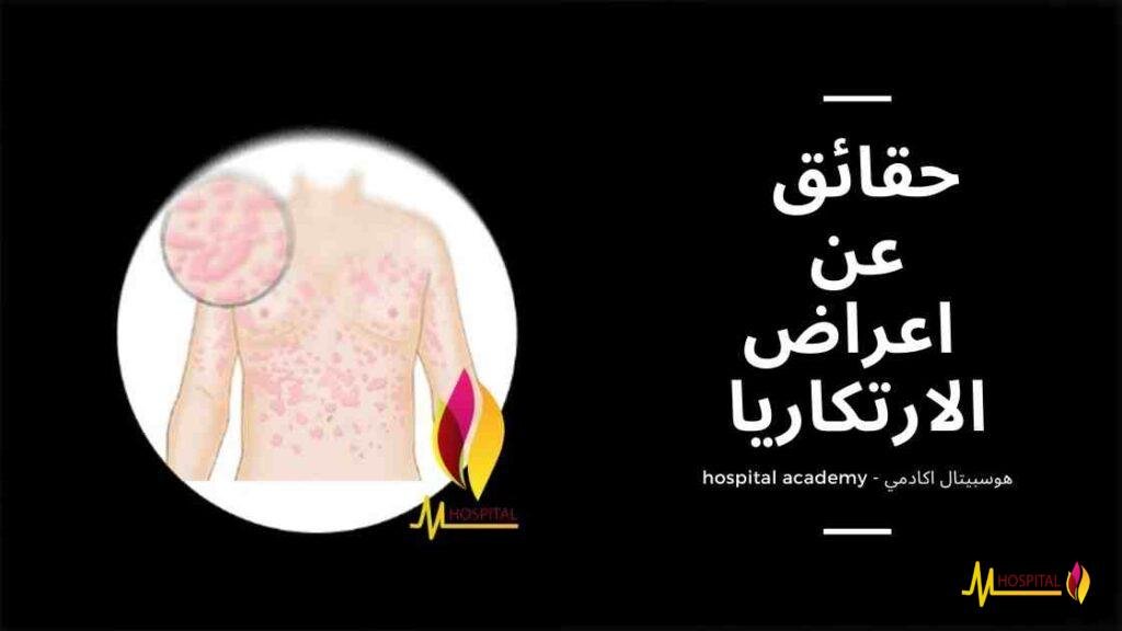 اعراض الارتكاريا , هوسبيتال اكادمي