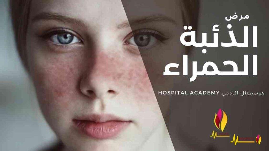 الذئبة الحمراء , هوسبيتال اكادمي