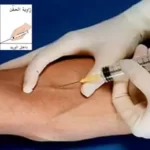 حقن الوريد - هوسبيتال اكادمي
