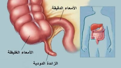 اعراض الزائده الدودية