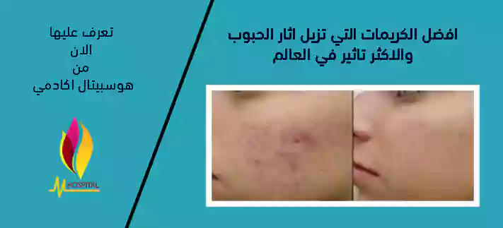 كريم لاثار الحبوب , هوسبيتال اكادمي