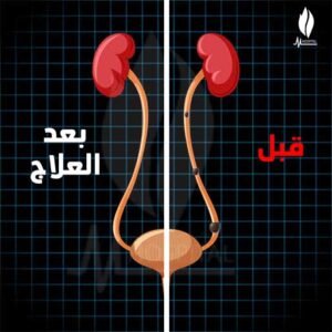 تمارين لإنزال حصوة الحالب , حصوة الحالب , هوسبيتال اكاديمي