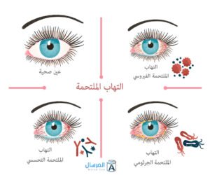 حساسية العين