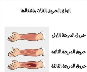 الاسعافات الاوليه للحروق