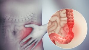 اسباب التهاب القولون , اعراض التهاب القولون , التهاب القولون 