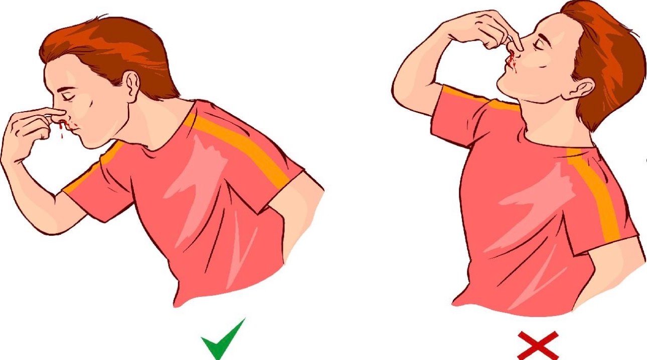 اسعافات اولية لكسر الانف بعد الاصابة