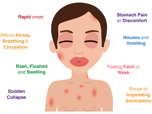 اسعافات اولية للحساسية المفرطة anaphylaxis