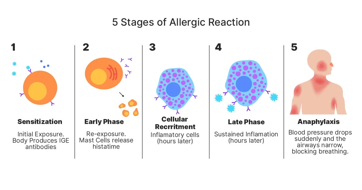 اسعافات اولية للحساسية المفرطة anaphylaxis