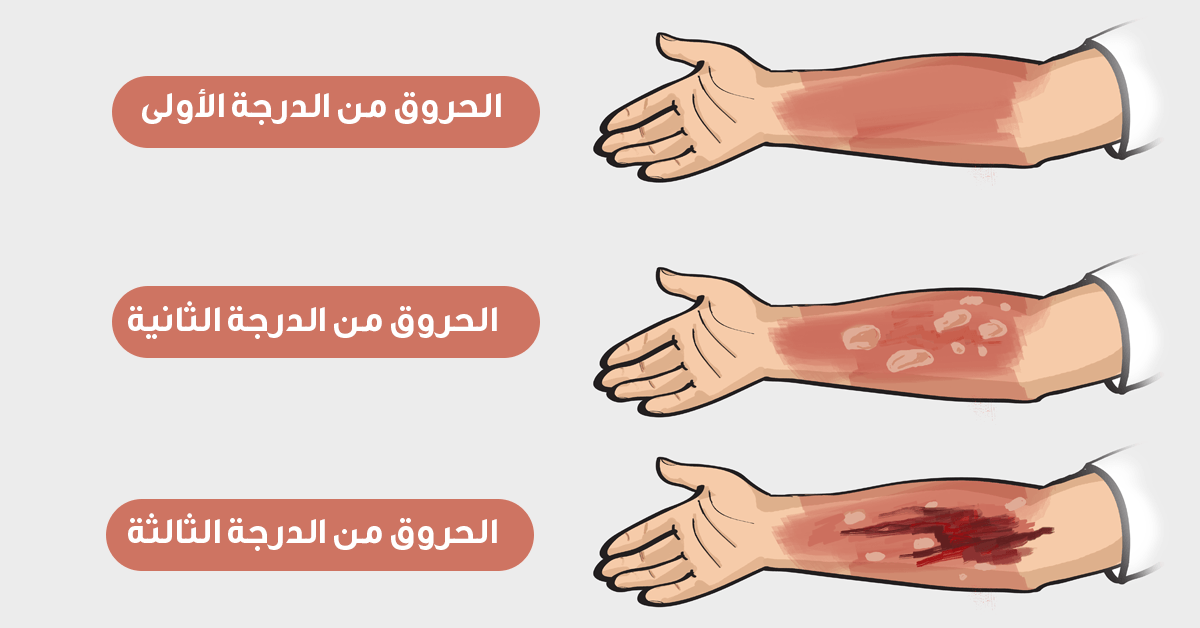 الفرق بين الحرق من الدرجة الاولى والثانية والثالثة
